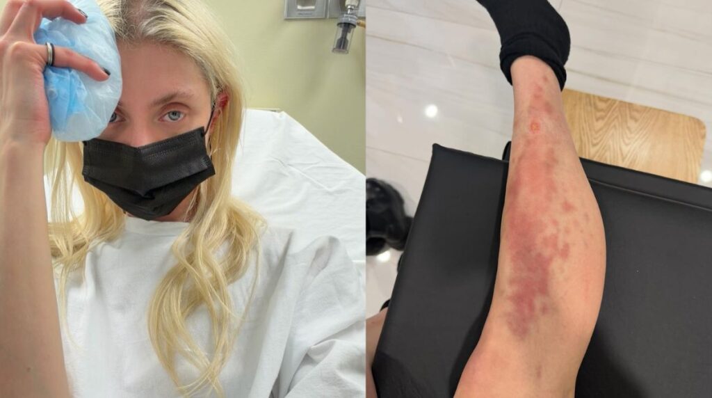 Taylor Momsen é Picada por Aranha e Hospitalizada, Mas Afirma: ‘O Show Tem que Continuar’ Taylor Momsen é Picada por Aranha e Hospitalizada, Mas Afirma: 'O Show Tem que Continuar'