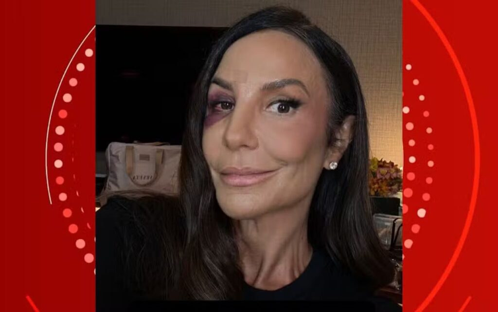Ivete Sangalo Compartilha Recuperação Após Queda e Ganha Apoio de Celebridades