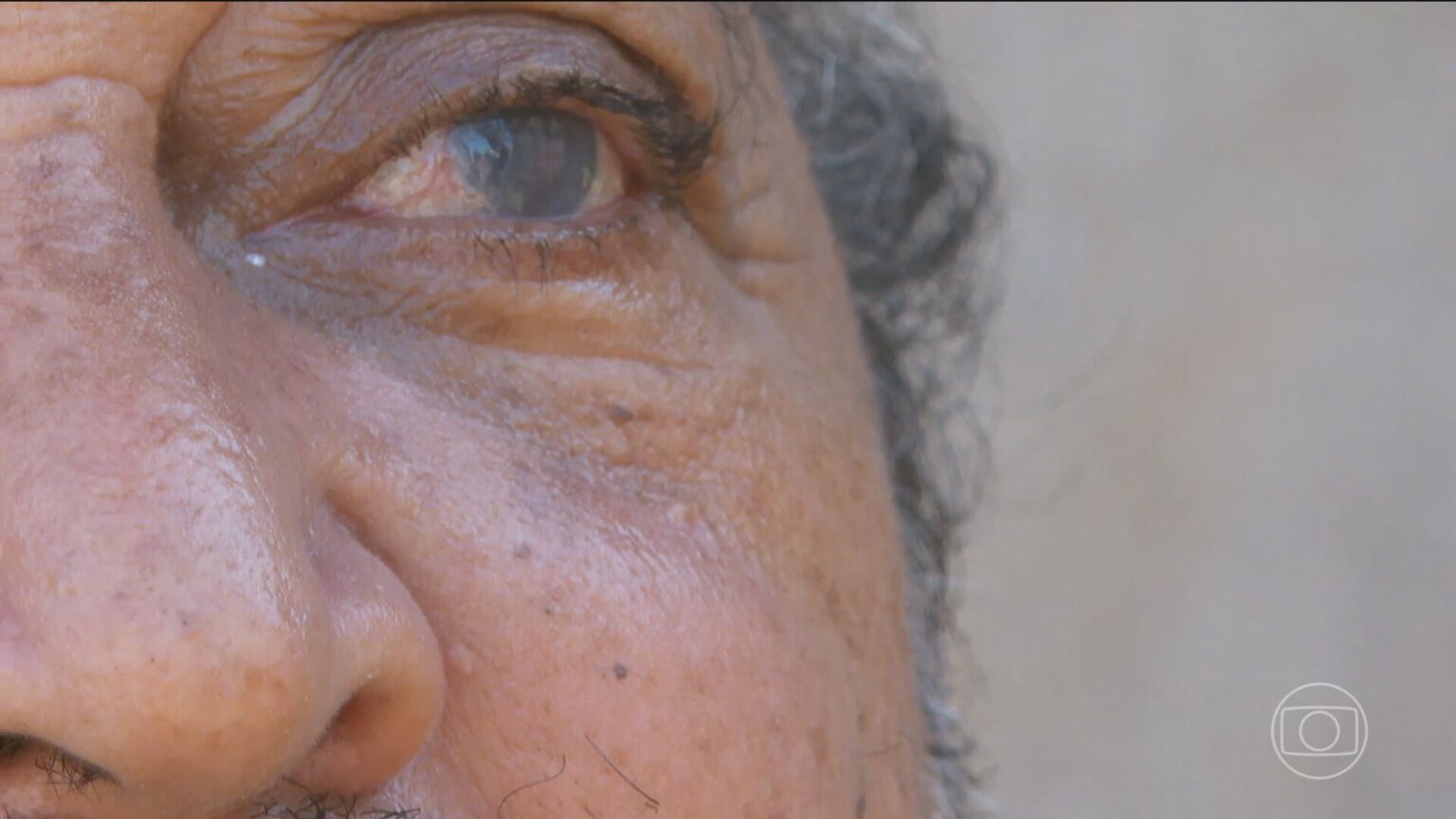 Pacientes Lesados em Mutirão de Cirurgias de Catarata: Um Ano Após Denúncias em SP