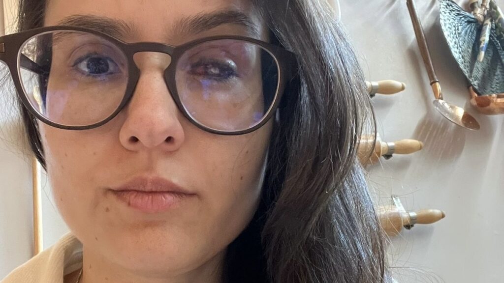 Terapeuta Enfrenta Transplante de Córnea Após Contaminação por Ameba em Lentes de Contato Terapeuta Enfrenta Transplante de Córnea Após Contaminação por Ameba em Lentes de Contato