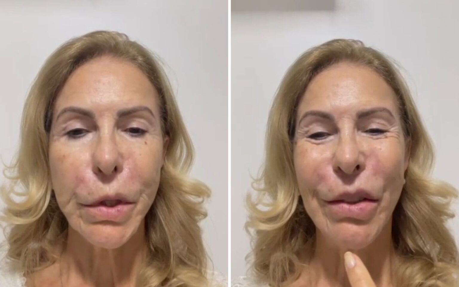 Psicóloga Denuncia Dentista por Sequelas Estéticas: ‘Meu Lábio Superior Não Movimenta’ Psicóloga Denuncia Dentista por Sequelas Estéticas: 'Meu Lábio Superior Não Movimenta'
