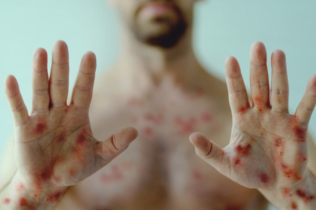 Minas Gerais Registra Quinto Caso de Mpox em 2024 – Conheça os Sintomas e Prevenção
