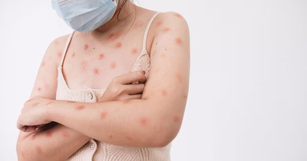 Mpox em Minas Gerais: Casos Confirmados Alarmam em Belo Horizonte