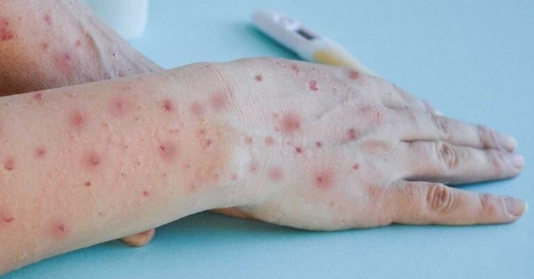 Mpox: Primeiro Caso de 2024 Confirmado no Brasil Durante o Carnaval