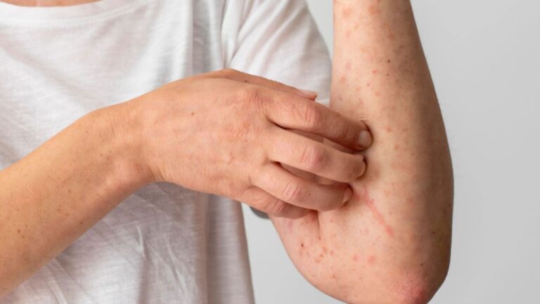 Atualização sobre os Casos de Mpox na Bahia: Cenário Atual e Detalhes