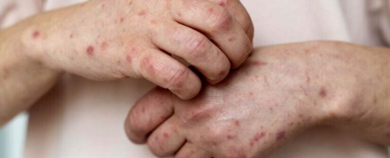 Caso de Mpox é Descartado em Vitória da Conquista: Bahia Registra Apenas um Caso Confirmado