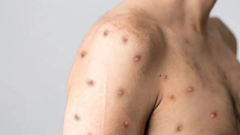 Mpox na Bahia: Dois Casos Confirmados e Outros em Investigação