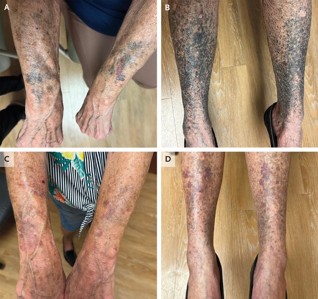 Idosa Americana Apresenta Pele Azulada e Preta Após Uso de Antibiótico: Estudo Revela Efeito Raro Idosa Americana Apresenta Pele Azulada e Preta Após Uso de Antibiótico: Estudo Revela Efeito Raro