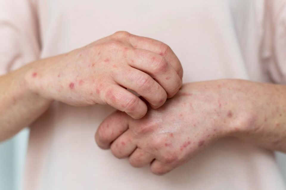 Mato Grosso em Alerta: Nova Variante da Mpox Avança em Rondônia Mato Grosso em Alerta: Nova Variante da Mpox Avança em Rondônia