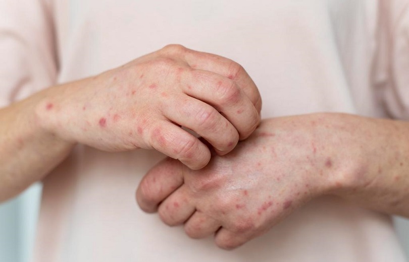 Cuiabá Não Registra Casos de Mpox e Mantém Vigilância Preventiva Ativa Cuiabá Não Registra Casos de Mpox e Mantém Vigilância Preventiva Ativa