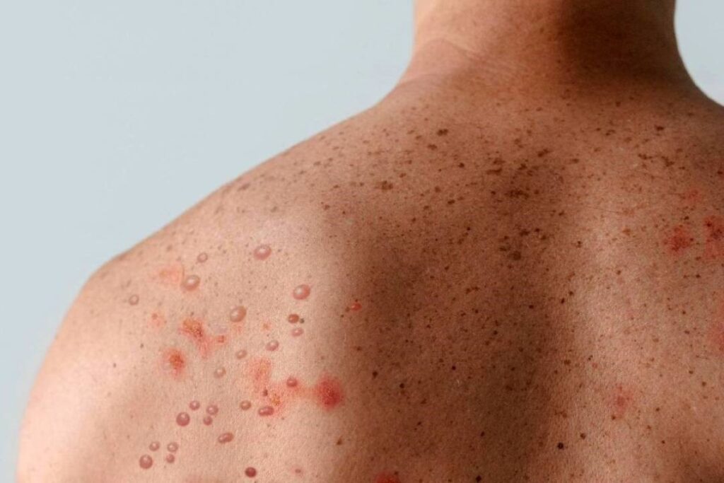 São Paulo registra 49 novos casos de mpox em apenas 6 dias