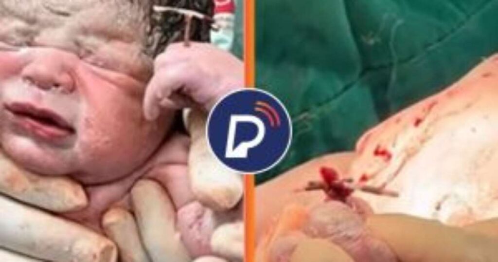 Bebê Surpreende ao Nascer Segurando DIU: Médica Celebra ‘Trofeu de Vitória’ Imagem do artigo
