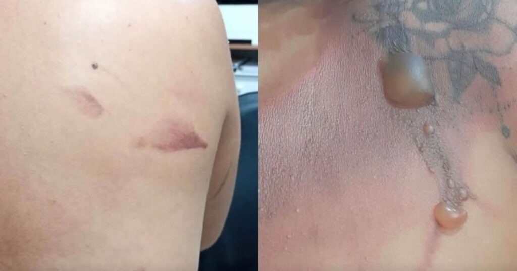 Homem é Detido por Agredir Companheira com Água Quente no Pará