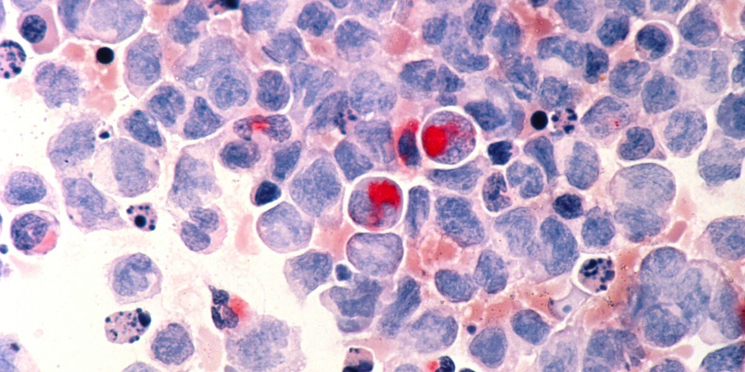 Fevereiro Laranja: A Importância da Doação de Medula Óssea