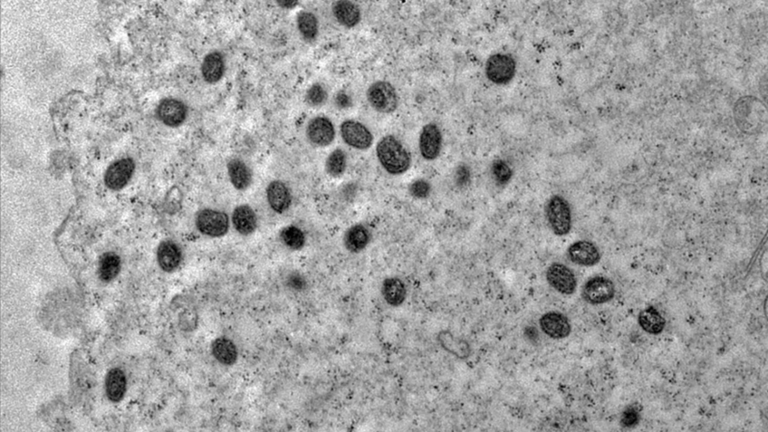 Casos de Mpox no Brasil Atingem 149 em 2026: Veja os Detalhes Casos de Mpox no Brasil Atingem 149 em 2026: Veja os Detalhes