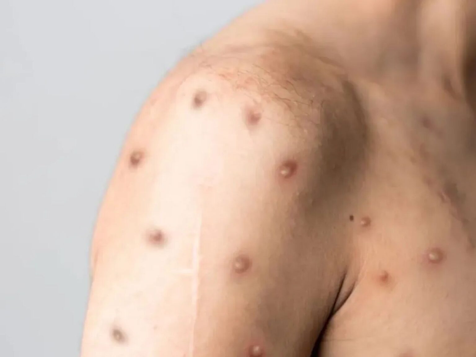 Casos de Mpox em Minas Gerais Atingem 13 Registros; Grande BH é a Principal Área Afetada Casos de Mpox em Minas Gerais Atingem 13 Registros; Grande BH é a Principal Área Afetada