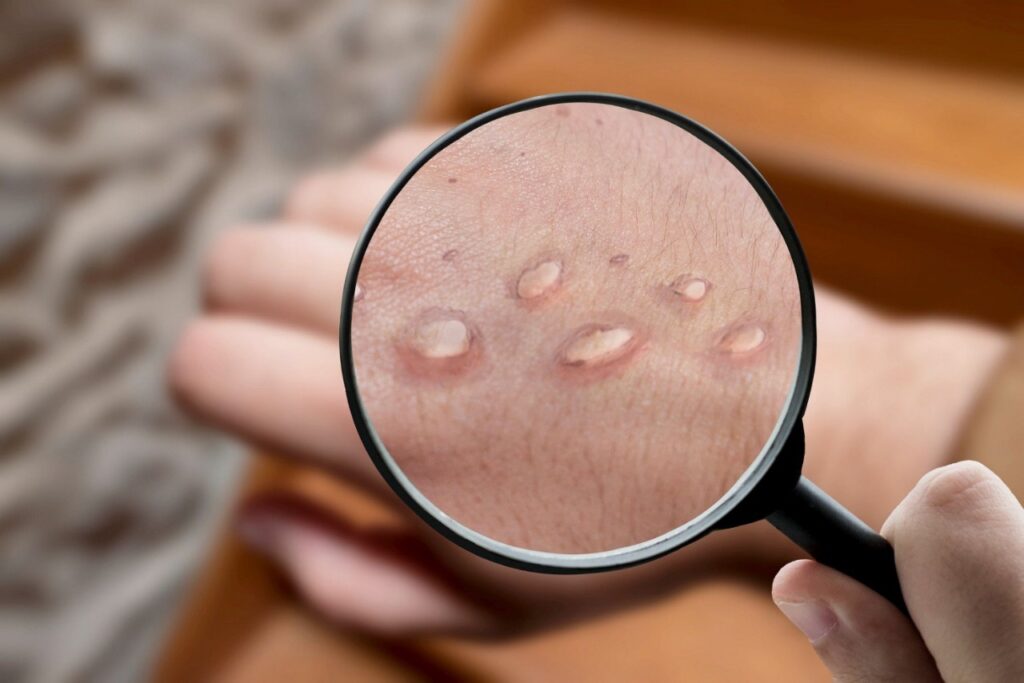 Números de Casos de Mpox em Minas Aumentam para 17: Entenda a Situação Atual