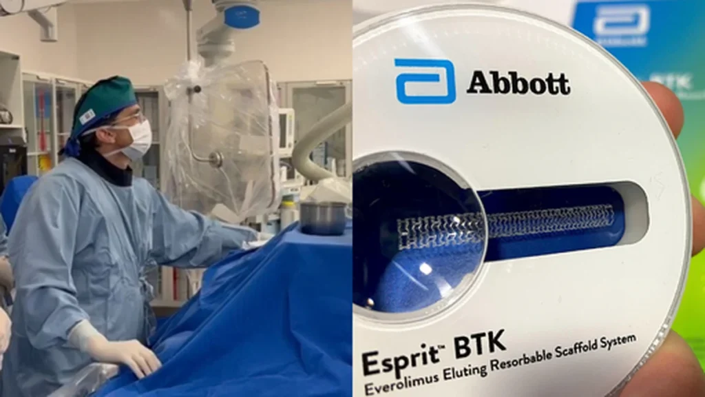 Hospital de Santa Maria inova com tecnologia bioabsorvível para tratar doenças arteriais Hospital de Santa Maria inova com tecnologia bioabsorvível para tratar doenças arteriais