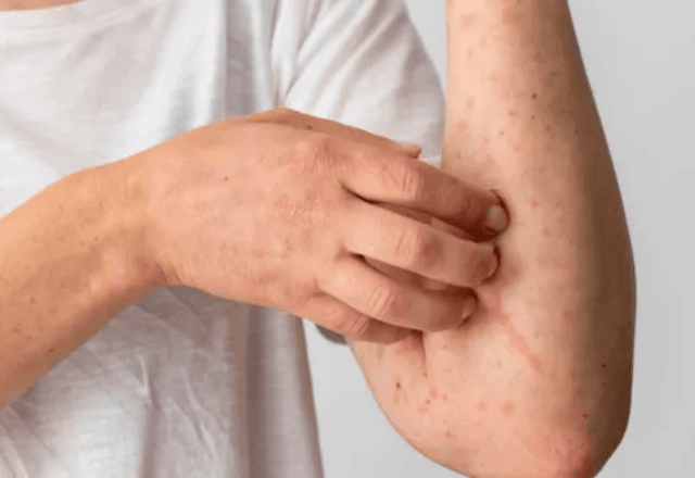 Minas Gerais Registra Quinto Caso de Mpox em 2026: Entenda a Doença Minas Gerais Registra Quinto Caso de Mpox em 2026: Entenda a Doença