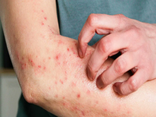 Bahia Registra 7 Casos Suspeitos de Mpox em 2026 sem Óbitos Relacionados Bahia Registra 7 Casos Suspeitos de Mpox em 2026 sem Óbitos Relacionados